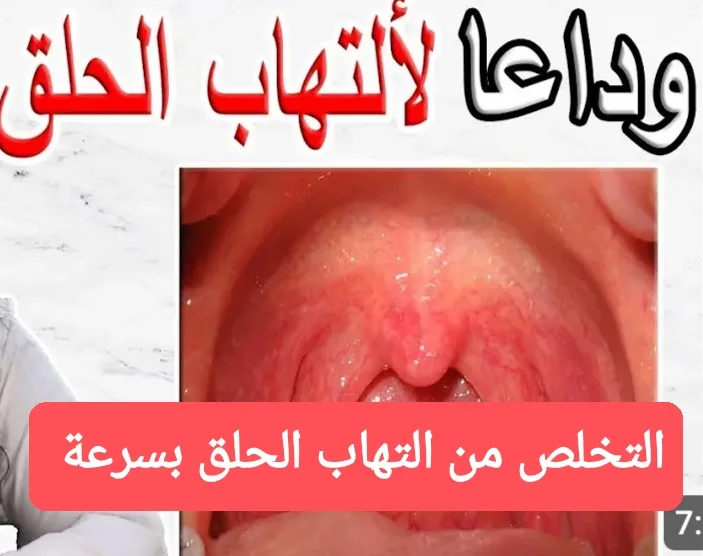 التخلص من التهاب الحلق بسرعة